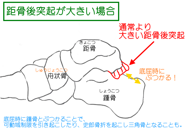 距骨後突起が通常よりも大きい場合も三角骨とみなされる。踵骨との衝突が起きやすく、疲労骨折して実際に三角骨になることもある。