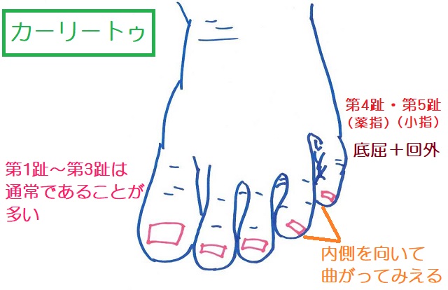 第4趾（薬指）と第5趾（小指）が内側に曲がって見える