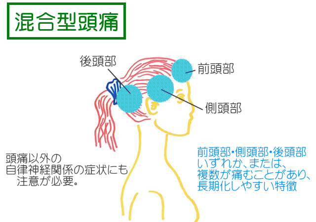 混合型頭痛の特徴は前頭部・側頭部・後頭部の複数箇所が長期に疼痛を発する