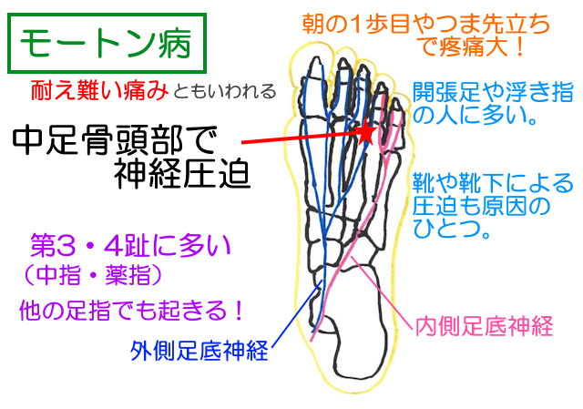 モートン病は中足骨頭部で足指のさきに行く神経が圧迫されて起きる耐え難い痛み。浮き指や開張足、靴の圧迫によって起きることが多い。第3・4趾間に起きることが多いが、他の指でも起きる。