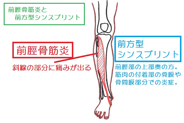 前脛骨筋炎と前方型シンスプリント
