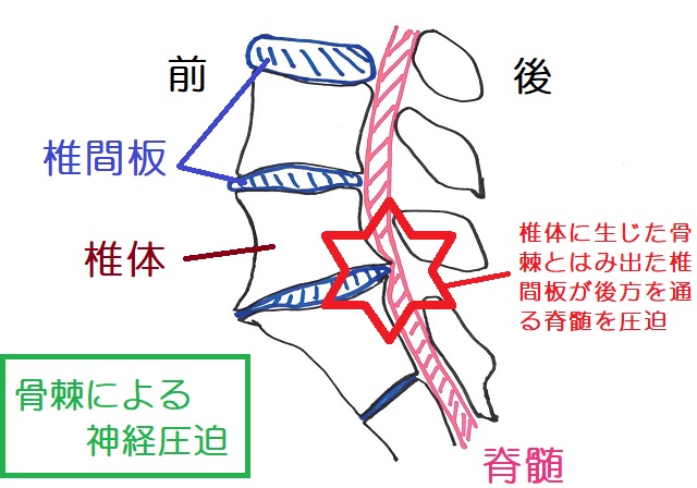 背骨の椎体に生じた骨棘によって後方を通る脊柱管や脊髄を圧迫してしまうことがある 