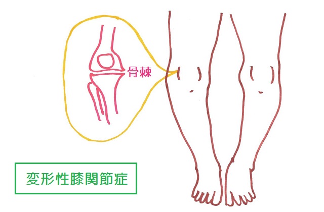 変形性膝関節症では膝関節の内側または外側に骨棘がみられることもある