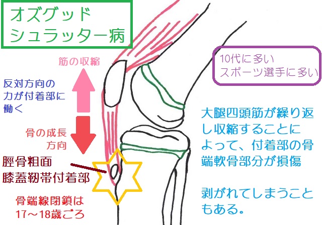 オズグッドしゅらーったー病は脛骨粗面の付着部で発生する
