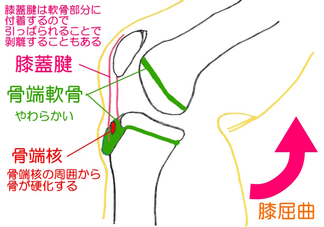 オスグッドシュラッター病は膝関節屈曲によって膝蓋腱が牽引されると脛骨粗面部の骨端軟骨が牽引されて隆起する。剥離することもある。
