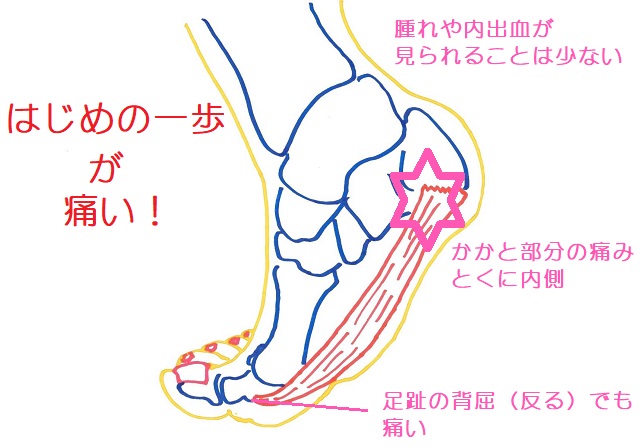 足底腱膜炎でははじめの一歩が痛い。促進p背屈でも痛みが生じる