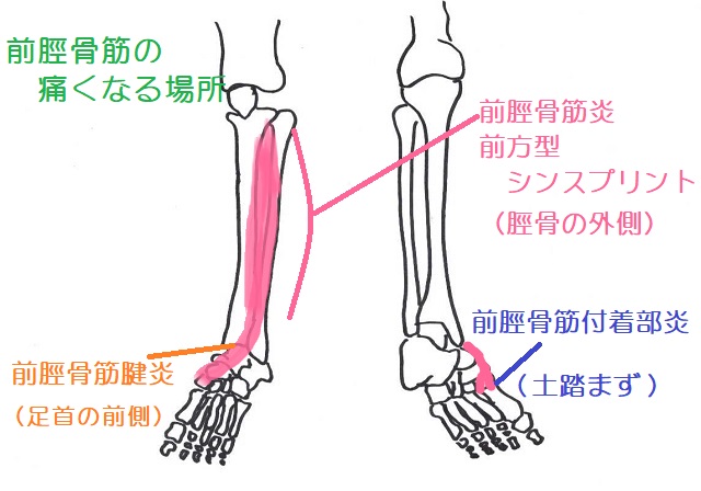前脛骨筋の痛みは筋・付着部・腱で痛みの出る場所が変わる