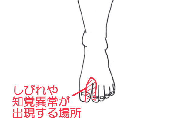 前足根管症候群でしびれや知覚異常の出る範囲は母趾つけ根外側半分～第2趾内側半分の背側。