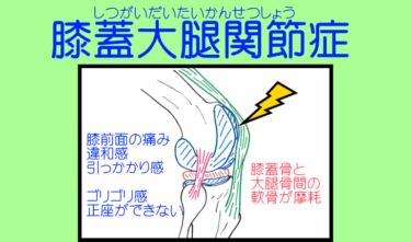 膝蓋大腿関節症の解説と対処法。膝の前面に痛み。