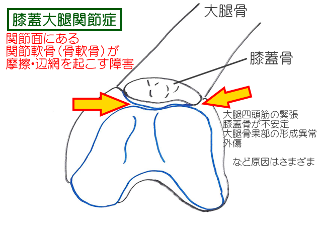 膝蓋大腿関節症では膝蓋骨の関節面と大腿骨滑車溝が摩擦・編成を引き起こす障害