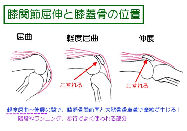 膝蓋大腿関節症では、膝関節の軽度屈曲～伸展で摩擦が生じやすく、日常でも歩行やランニングなどで使われているレンジでこすれることが分かる