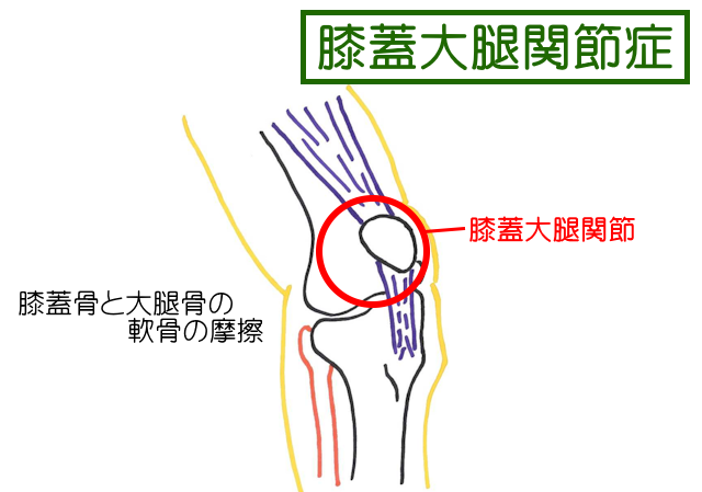 膝蓋大腿関節症は、膝蓋骨の下面にある関節軟骨と大腿骨にある滑車溝の関節軟骨が摩擦を起こして痛みが生じる