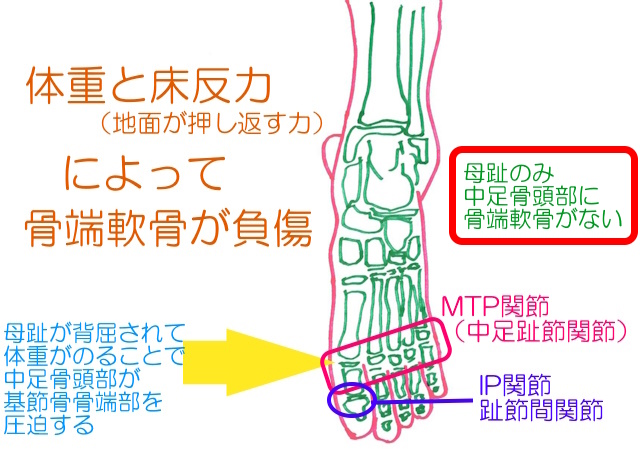 第一中足骨頭部のみ骨端軟骨はない。母趾背屈で荷重されることで基節骨骨端軟骨に負荷がかかる