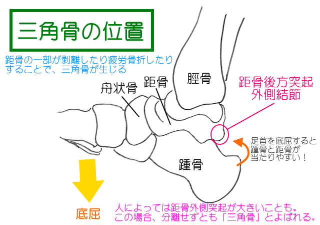 三角骨は距骨後方突起外側結節が分離したもののことが多いが、結節が大きく分離せずとも三角骨と呼ばれる。 長母趾屈筋腱とも擦れやすく、機械的刺激が大きい。