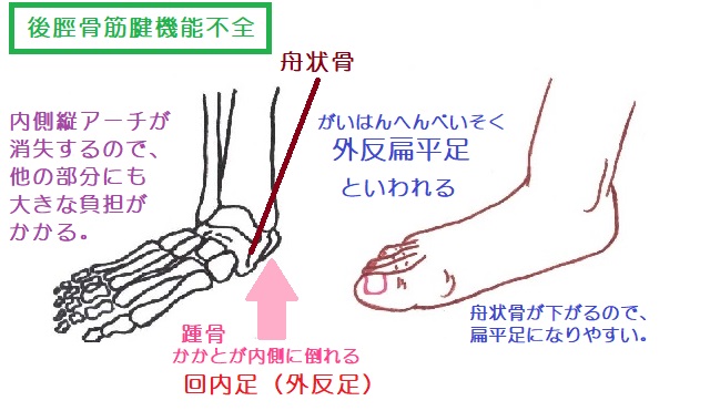 後脛骨筋腱機能不全では踵骨の回内（外反）と舟状骨が下方に移動することが問題となる