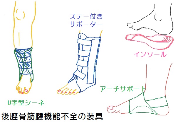 後脛骨筋腱機能不全ではU字型シーネ、ステー付きサポーター、インソール、アーチサポートなどの装具を使用する