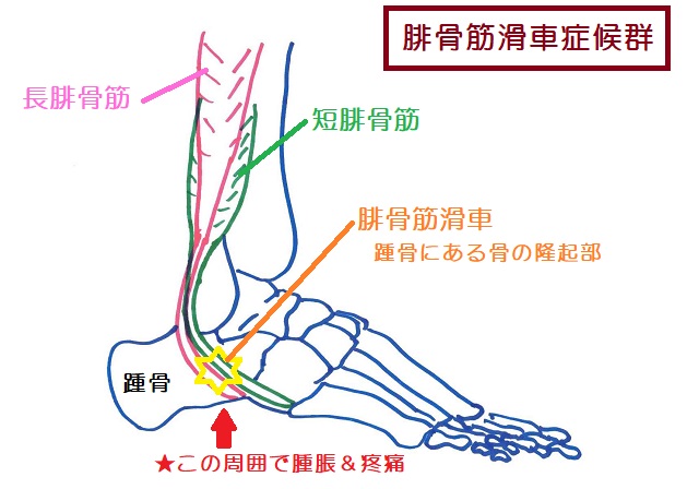 腓骨筋滑車症候群は踵骨にある隆起部で腓骨筋腱が摩擦を起こして腱鞘炎を発症