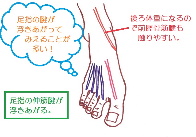 浮き指の足は伸筋腱が浮いて見える