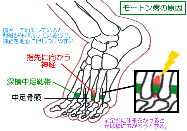 モートン病の原因。前足部に荷重すると広がるので、深横中足靱帯が伸びる。これによって趾間にある神経が地面に押しつけられることで発症する