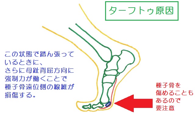 ターフトゥは母趾MTP関節背屈で踏ん張っているときにさらに荷重を受けることで生じる。