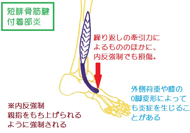 短腓骨筋腱付着部炎は繰り返しの牽引による他、内反強制や外側荷重、Okyaku 変形によっても生じる
