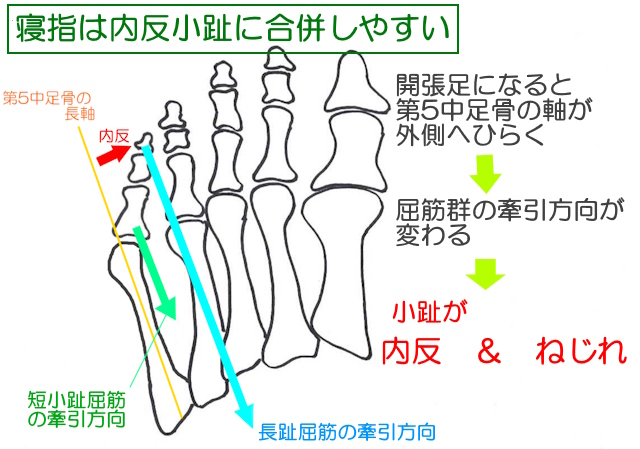 開張足などによって第５中足骨の長軸が外側にずれると小趾の屈筋群によって小趾の季節こちが内転、外旋することで、内反小趾や寝指が生じる。