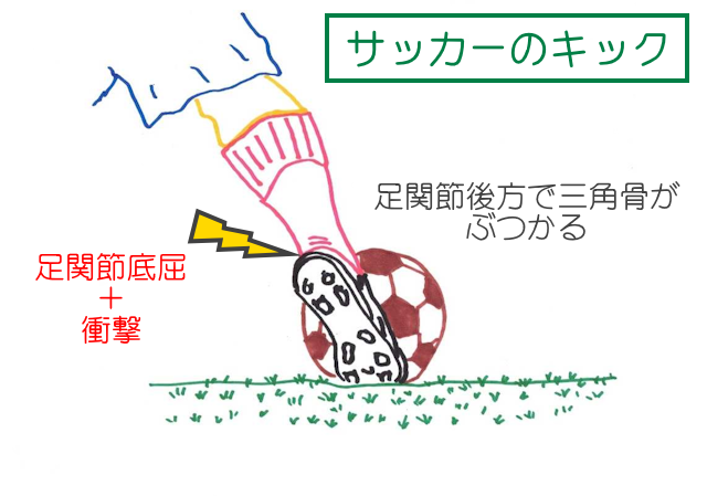 サッカーのインステップキックでは底屈強制に衝撃が加わるので三角骨障害が起きやすい