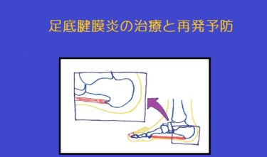 足底腱膜炎や有痛性踵骨棘は治るまでに時間がかかる！治療と再発予防。