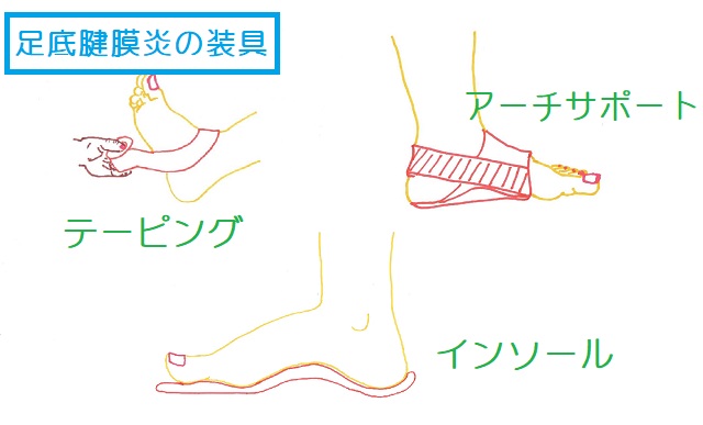 足底腱膜炎の装具療法。テーピング、アーチサポートバンド、インソール、ヒールカップ 
