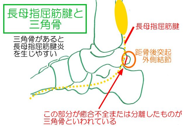 長母趾屈筋腱は距骨後突起と擦れて炎症を引き起こすことがある。 長母趾屈筋腱炎は足首後ろの痛み。
