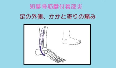 足の外側の骨が痛い！「短腓骨筋腱付着部炎」原因と再発予防。