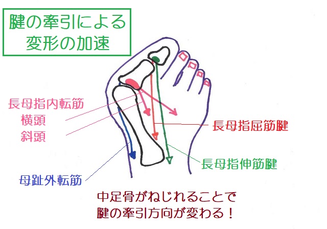 腱の牽引方向が外反母趾を悪化させる