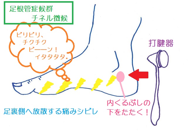 足根管症候群のチネル徴候