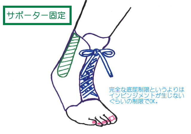 三角骨の固定は、急性期でなければインピンジメントが起きない程度の底屈制限で大丈夫