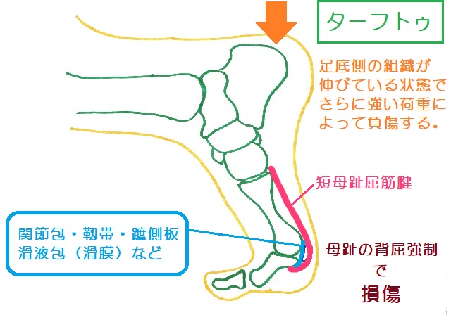 ターフトゥは母趾背屈状態でさらに背屈強制を受けることで、MTP関節底側の軟部組織が損傷して起きる