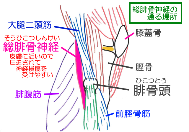 総腓骨神経は腓骨頭の後方を通り、巻き付くようにして前方へ移動するので圧迫を受けやすい。