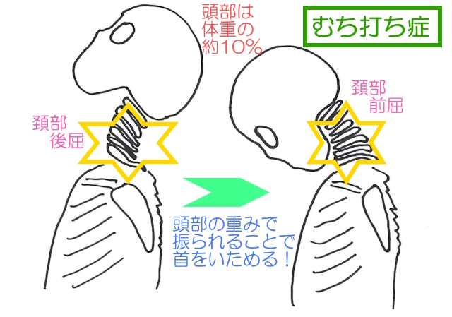 急激かつ過度に頸が後屈・前屈・側屈することで軟部組織が損傷したり、神経がダメージを受けるのがむち打ち症