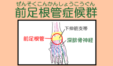 「前足根管症候群」深腓骨神経を圧迫、第1~2趾間のしびれが特徴
